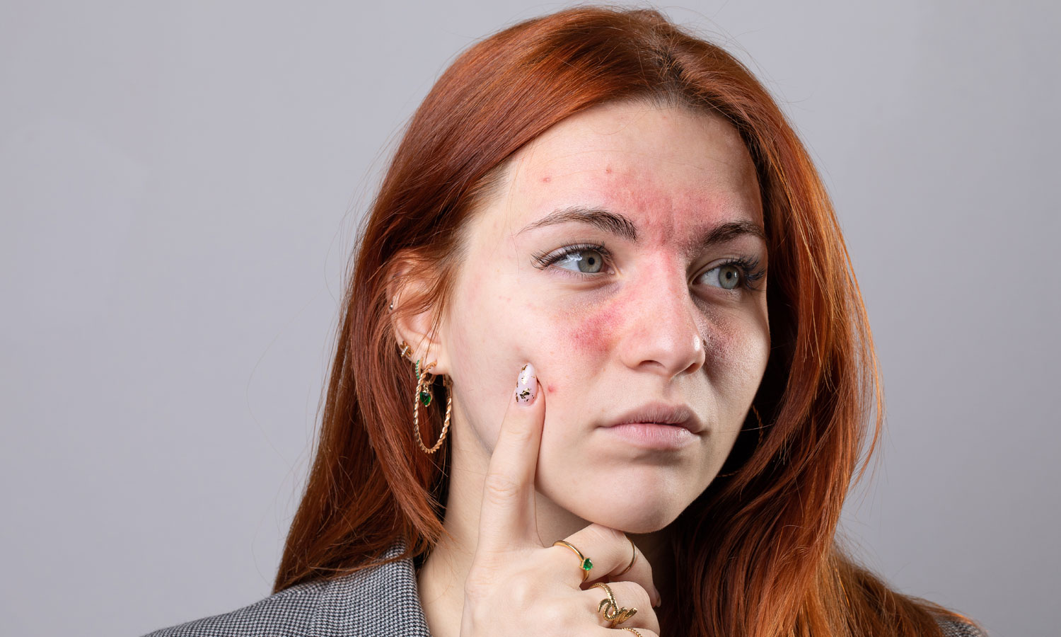 Rosacea
