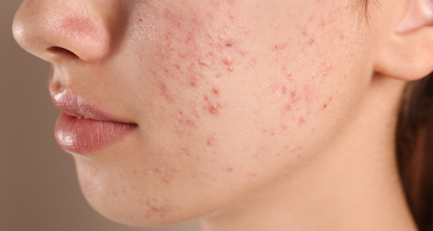 Stress and Skin