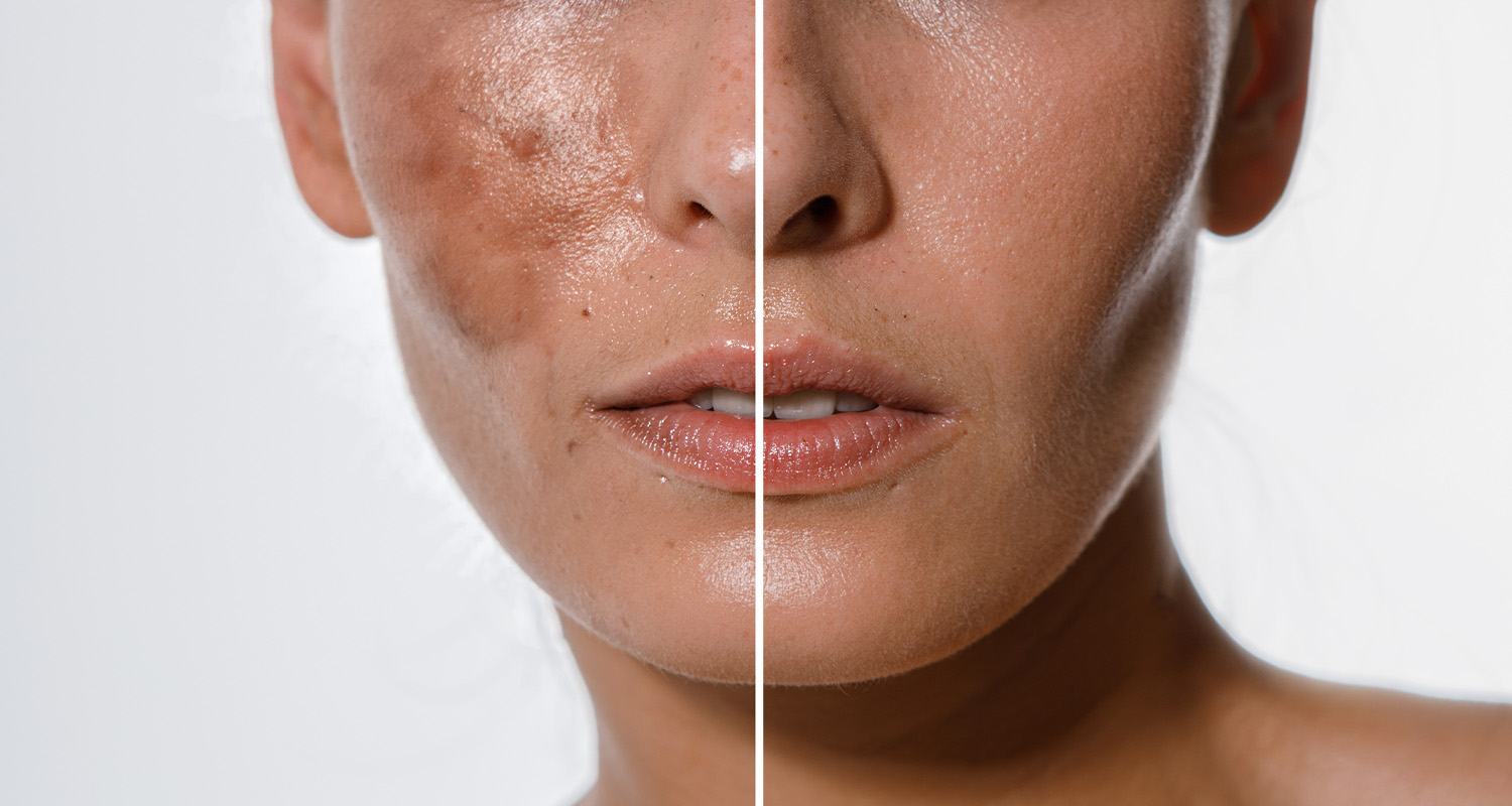 Skin Brightening