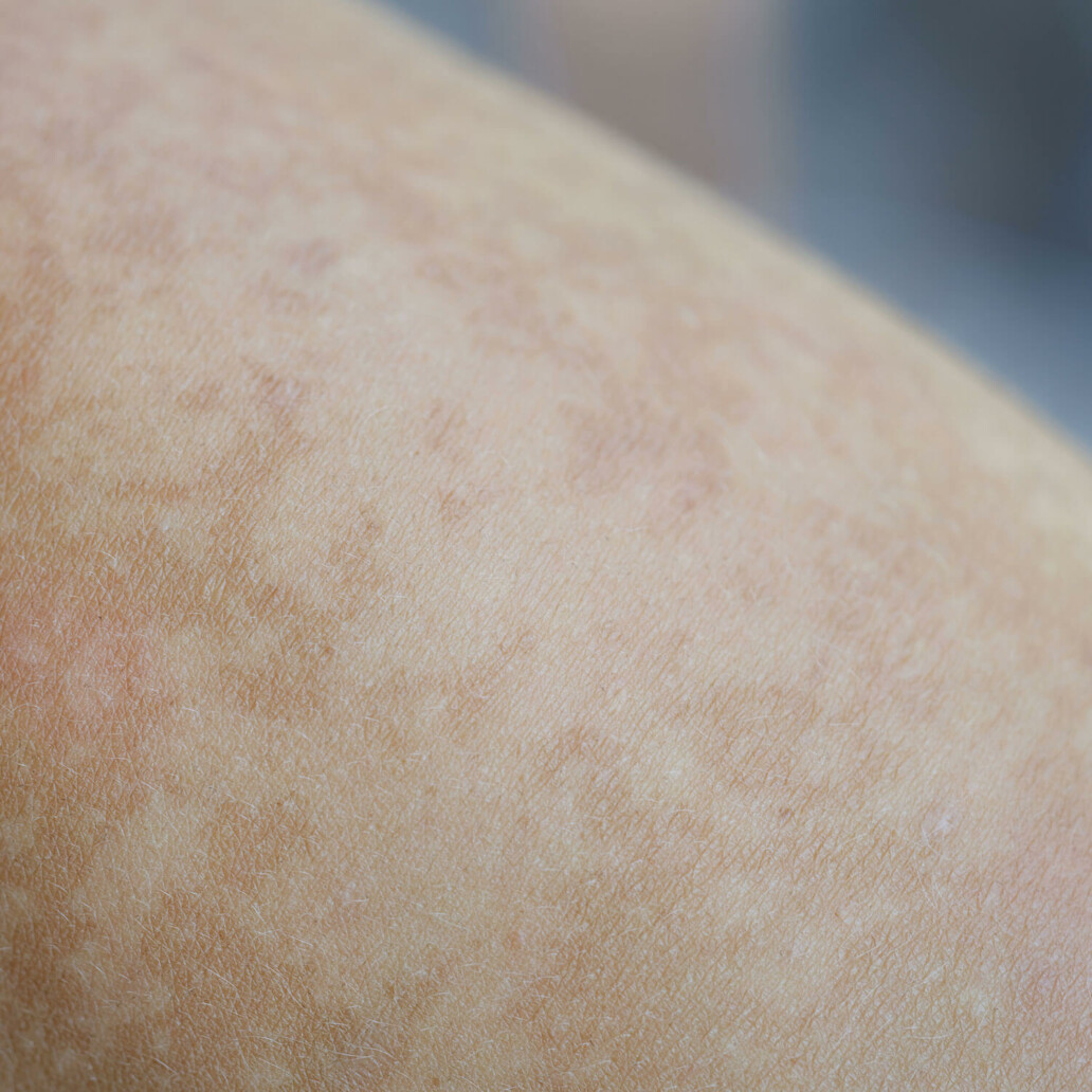 skin