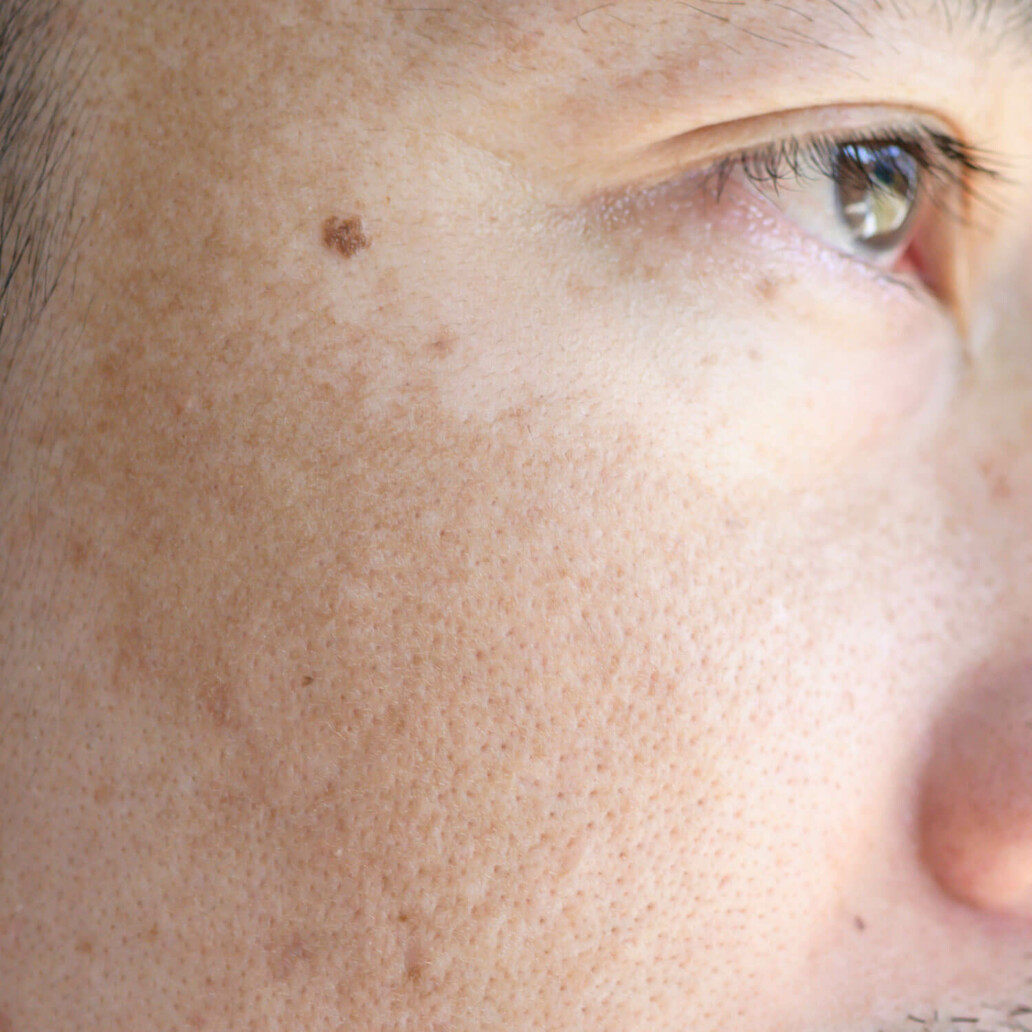 skin