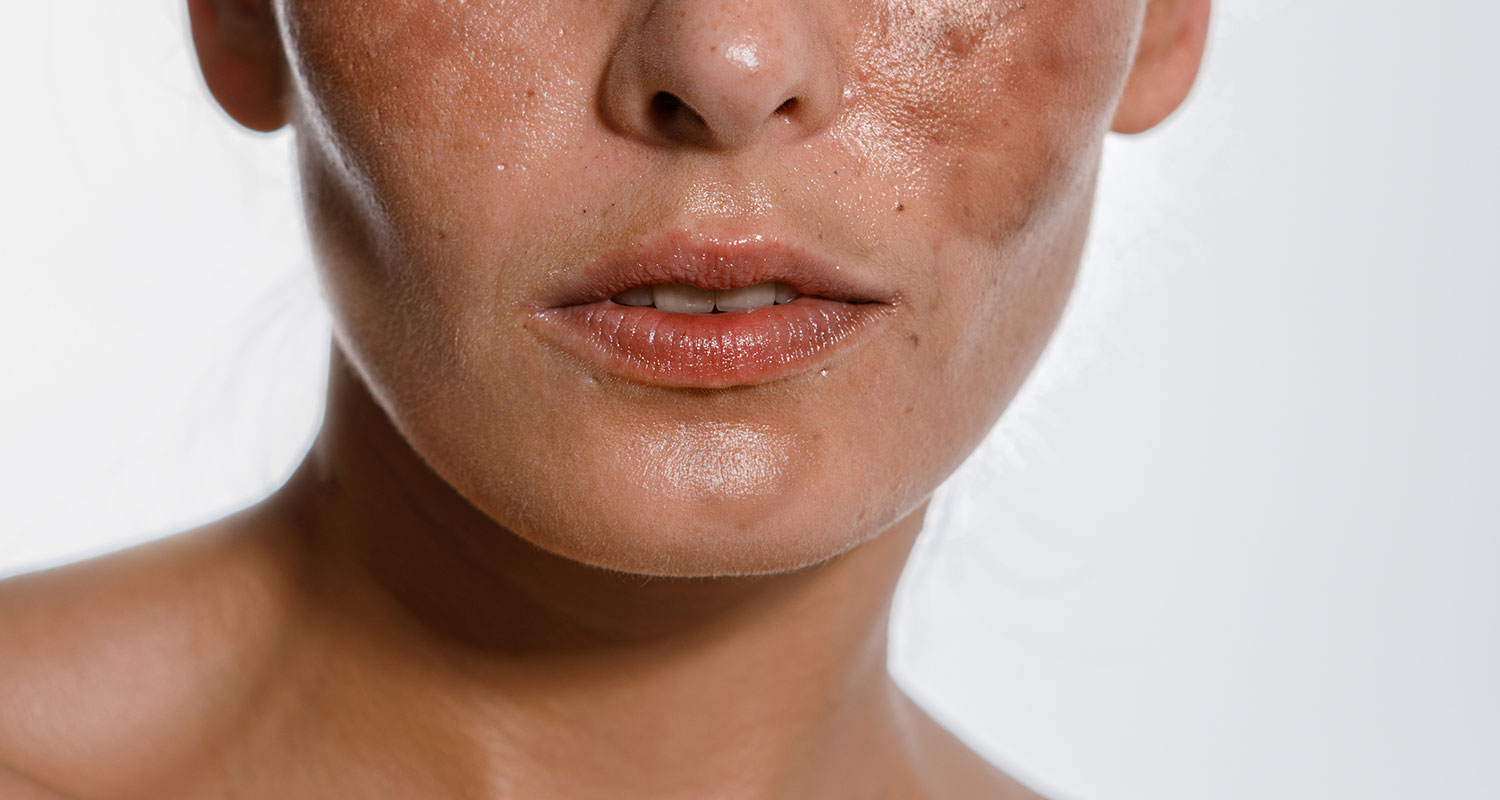 Tackling Hyperpigmentation: Effective Solutions at Sublime MediSpa in Ottawa