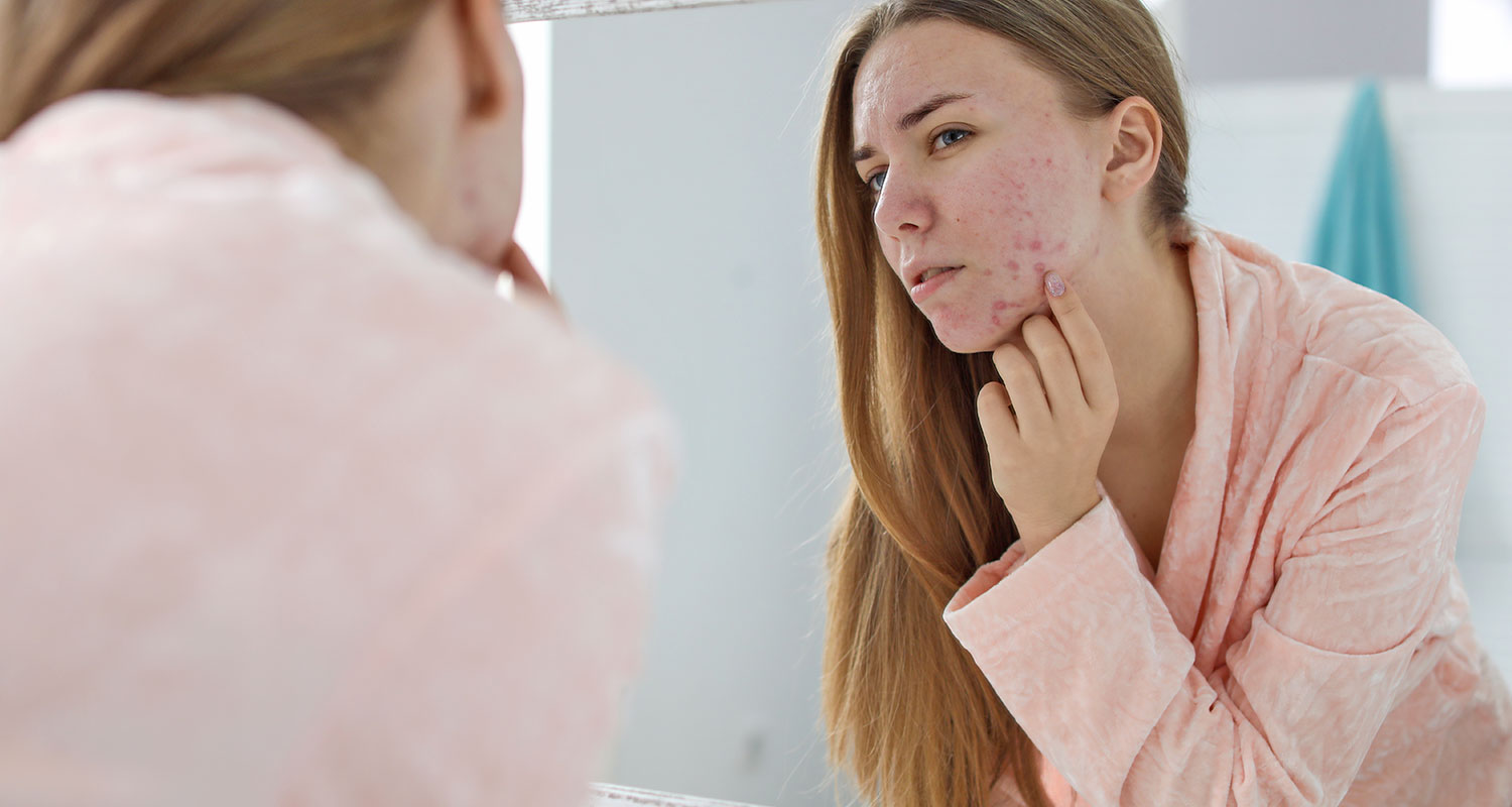Battling Acne in Ottawa: Innovative Treatments at Sublime MediSpa