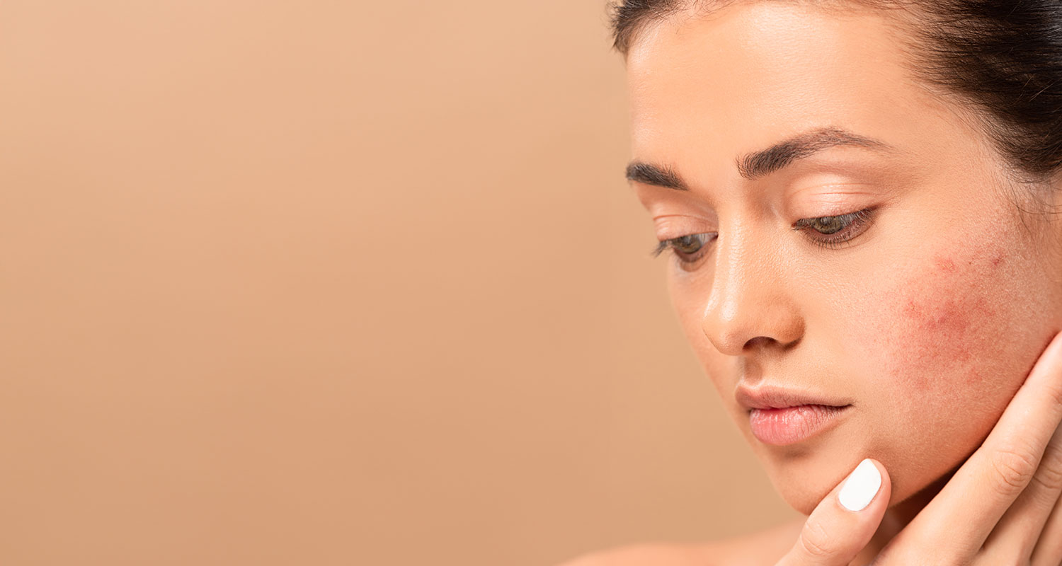 Conquering Rosacea: Effective Treatments at Sublime MediSpa in Ottawa