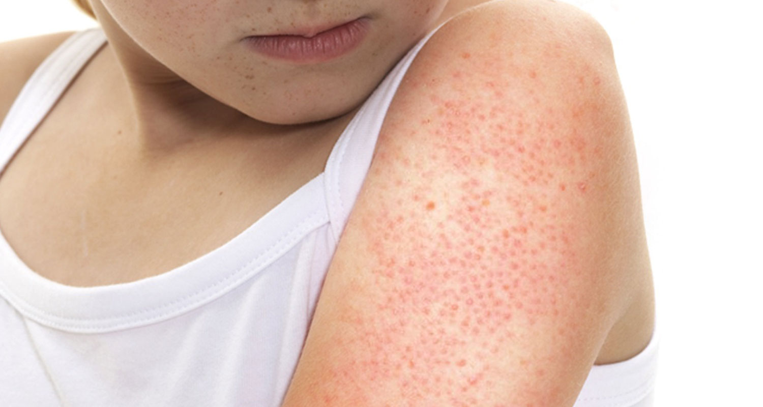 Conquering Keratosis Pilaris: Advanced Treatment Options in Ottawa at Sublime MediSpa