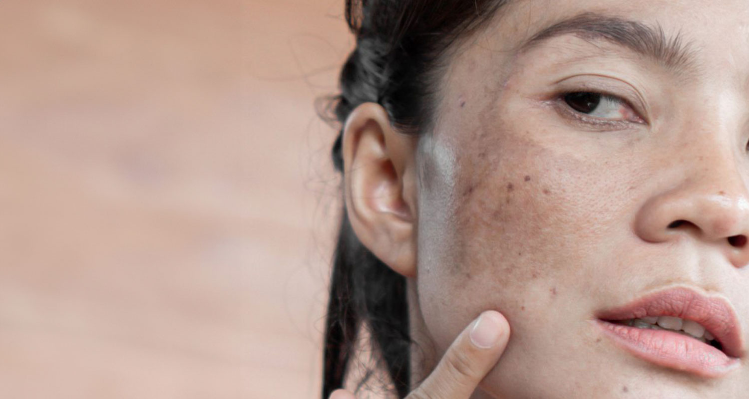 Battling Sun Damage in Ottawa: Effective Solutions from Sublime MediSpa