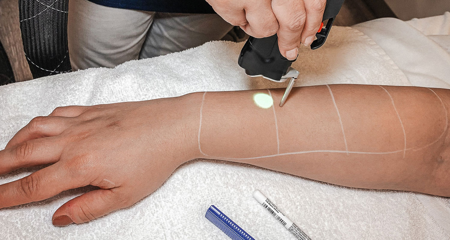 laser hair removal