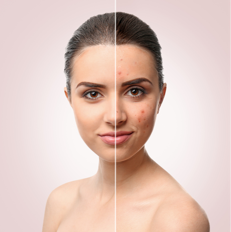 acne treatments