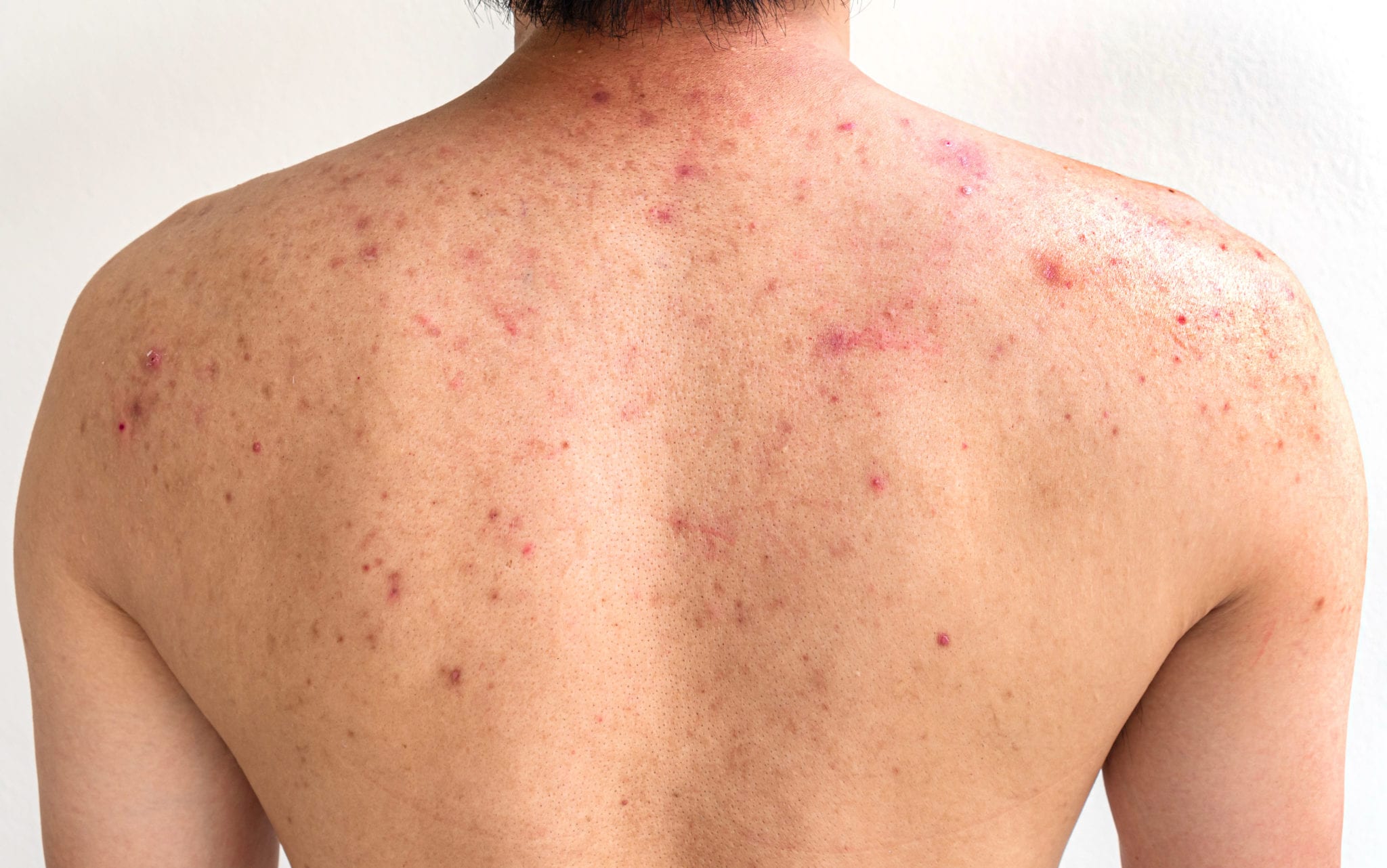 Back Treatments for Acne