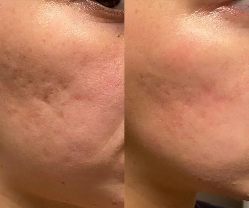 Microneedling for Active Acne